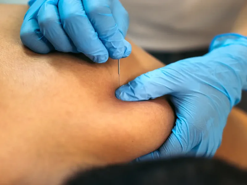 Dr. Moy performing dry needling on a patient&rsquo;s upper back at Amplify Physical Therapy and Wellness in Bolingbrook
