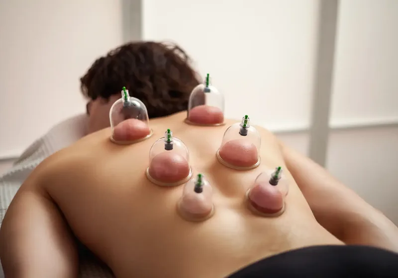 Therapist applying cupping therapy along a patient&rsquo;s back