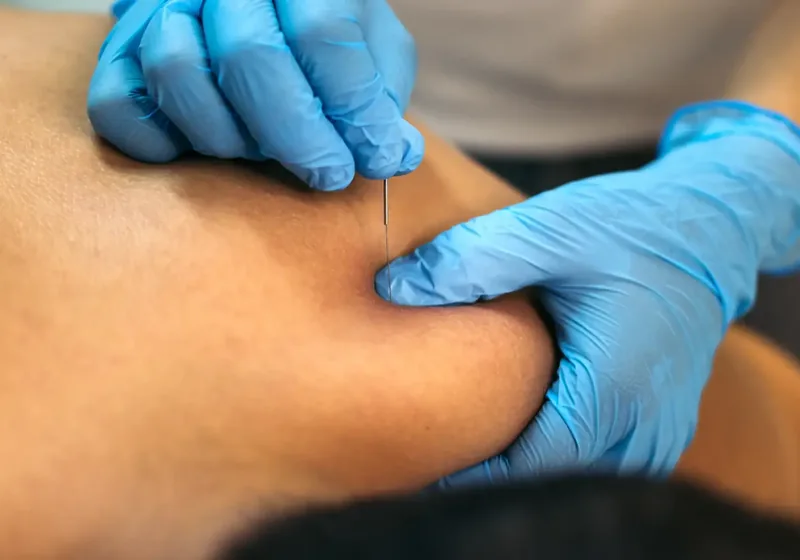 Clinician performing dry needling trigger-point treatment