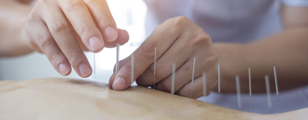 Dry Needling - Amplify Physical Therapy and Wellness in Bolingbrook, IL