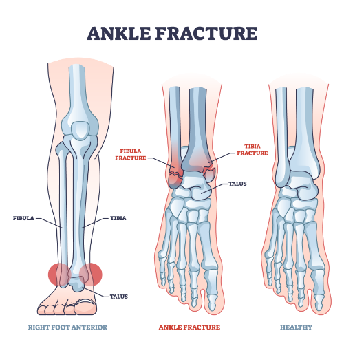 Ankle-Pain-Amplify-Physical-Therapy-and-Wellness-Bolingbrook-IL – 1