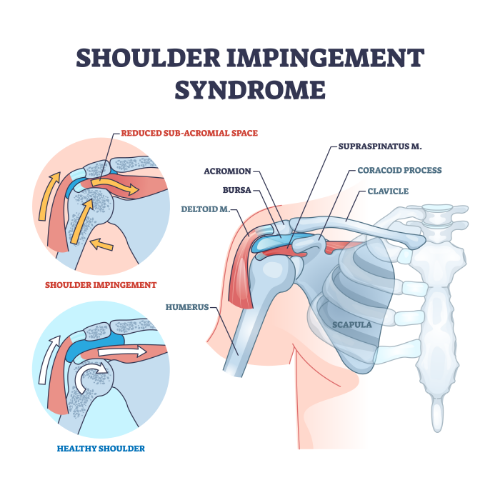 shoulder-pain-relief-Amplify-Physical-Therapy-and-Wellness-Bolingbrook-IL