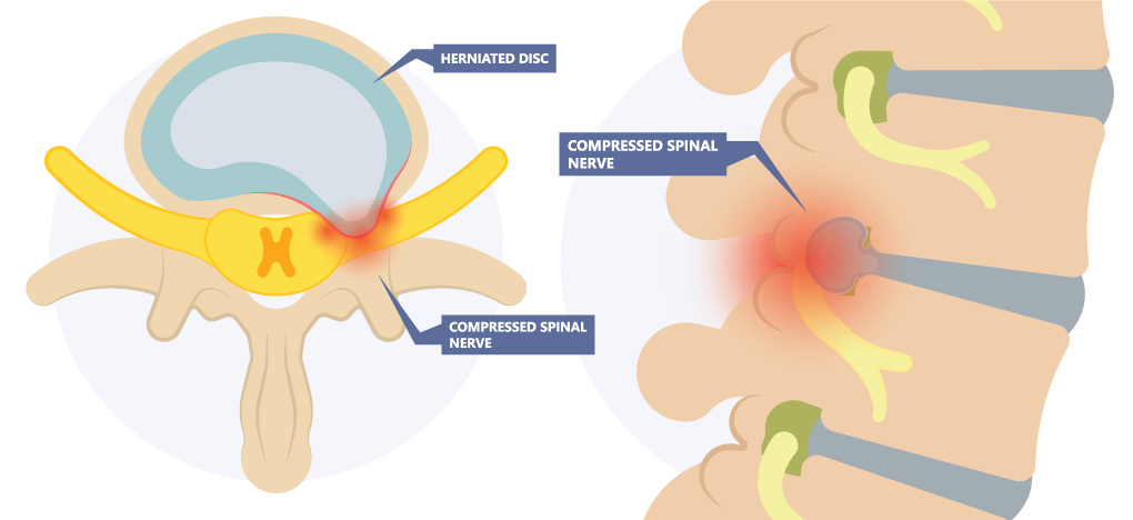 Back Pain Relief - Amplify Physical Therapy and Wellness in Bolingbrook, IL