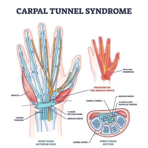 wrist-pain-relief-Amplify-Physical-Therapy-and-Wellness-Bolingbrook-IL