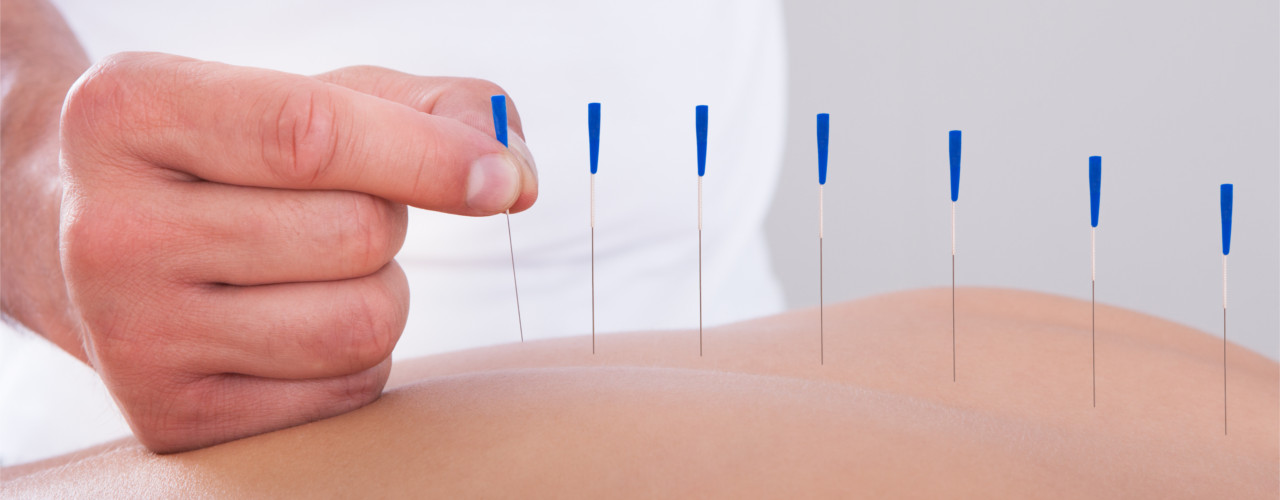 Dry Needling - Amplify Physical Therapy and Wellness in Bolingbrook, IL