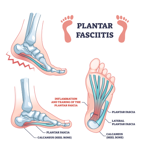 foot-pain-relief-amplify-physical-therapy-and-wellness-bolingbrook-il