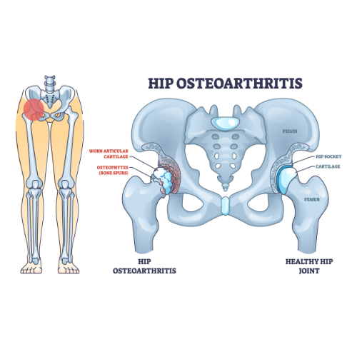 hip-pain-relief-amplify-physical-therapy-and-wellness-bolingbrook-il