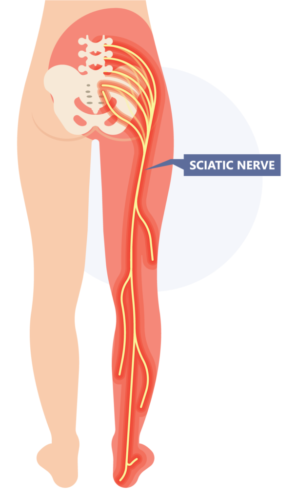 Sciatica Relief - Amplify Physical Therapy and Wellness in Bolingbrook, IL